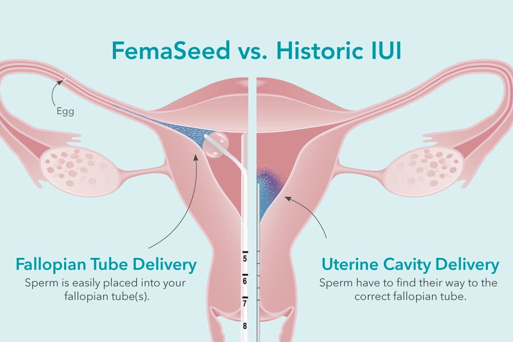 Femaseed vs. historic IUI